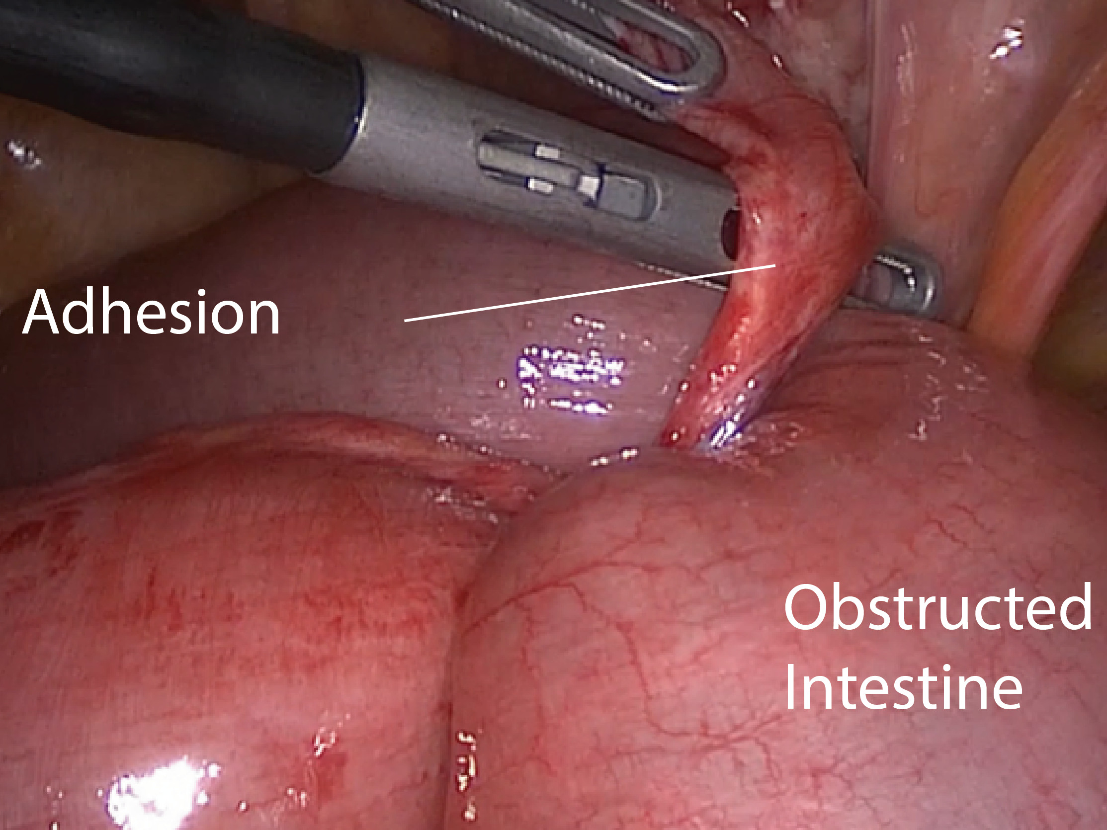 Verwachsungen (Adhesion) nach Operation im Bauchbereich: Hier eine Adhäsion mit einer partiellen Einschnürung des Dünndarms (Obstructed small intestine). Foto: J. Zindel, © Insel Gruppe