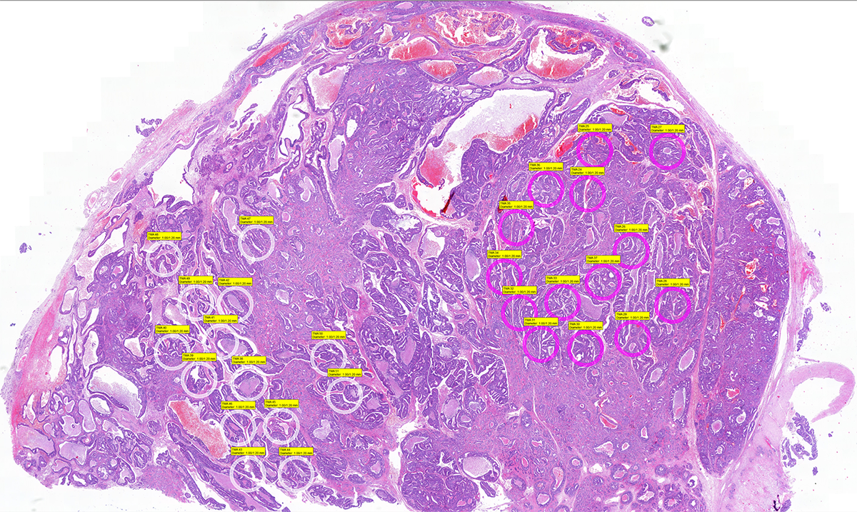 Gewebeschnitt einer Hirnmetastase eines Prostatakarzinoms mit ausgewählten intratumoralen Bereichen (rosa und weisse Kreise) für die Durchführung molekularer Analysen.