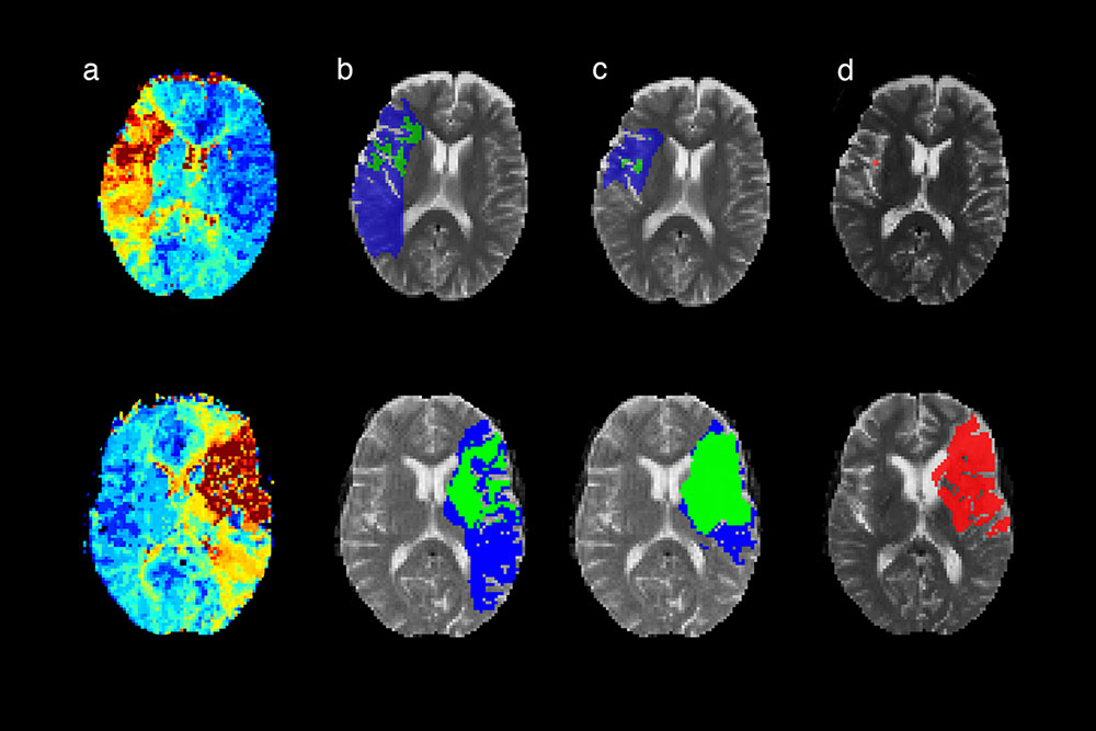 Das Bild zeigt verschiedene Gehirnscans – sowohl herkömmliche Bildgebung als auch Bilder der neuen Software FASTER. Im Gegensatz zur herkömmlichen Bildgebung (B) unterscheidet FASTER (C) präziser zischen rettbarem fehldurchbluteten Gewebe (blau) und Hirngewebe das geschädigt bleiben wird (grün). Bleibende Hirnschäden sind rot markiert (D). (A) zeigt das schwer zu interpretierende Bild der Hirndurchblutung. Wenn der Patient wie im ersten Fall hohe Chancen auf eine Verbesserung hat (fast keine bleibende Schädigung), wählen die Mediziner die invasive Befreiung des verstopften Blutgefässes mittels Katheter.