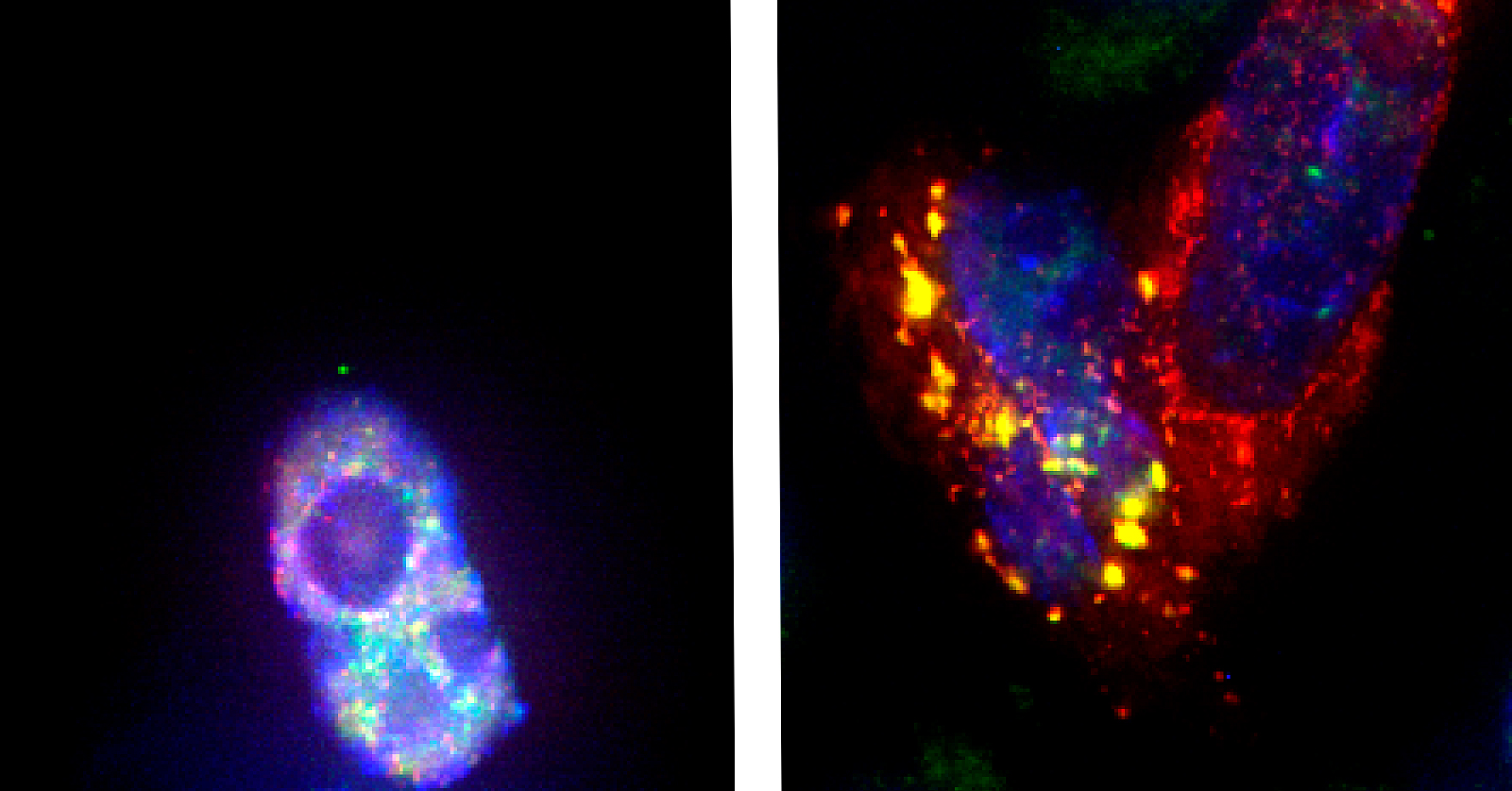 Das Protein FUS in seiner gewöhnlichen Form (links) und in der ALS-auslösenden mutierten Form (rechts). Der Kern (also die DNA) wird blau angezeigt; das FUS-Protein rot. Bild: The EMBO Journal.