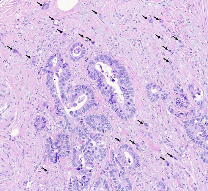 Das Bild zeigt Tumorknospen (sogenannte Tumor-Buds, markiert durch die schwarzen Pfeile) die sich als Einzelzellen oder kleine Zellgruppen von der Tumorfront ablösen und in das umgebende Gewebe eindringen. Bild: Universität Bern, Institut für Pathologie