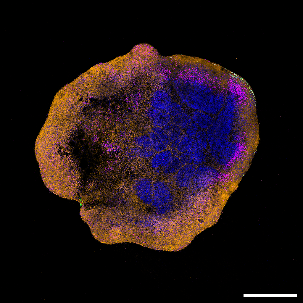 Hirnorganoid, welches mit dem Affenpockenvirus (MPXV) infiziert ist. Die DNA der Zellkerne ist blau gefärbt. MPXV ist grün dargestellt und an der Peripherie erkennbar. Massstab: 1000 μm.