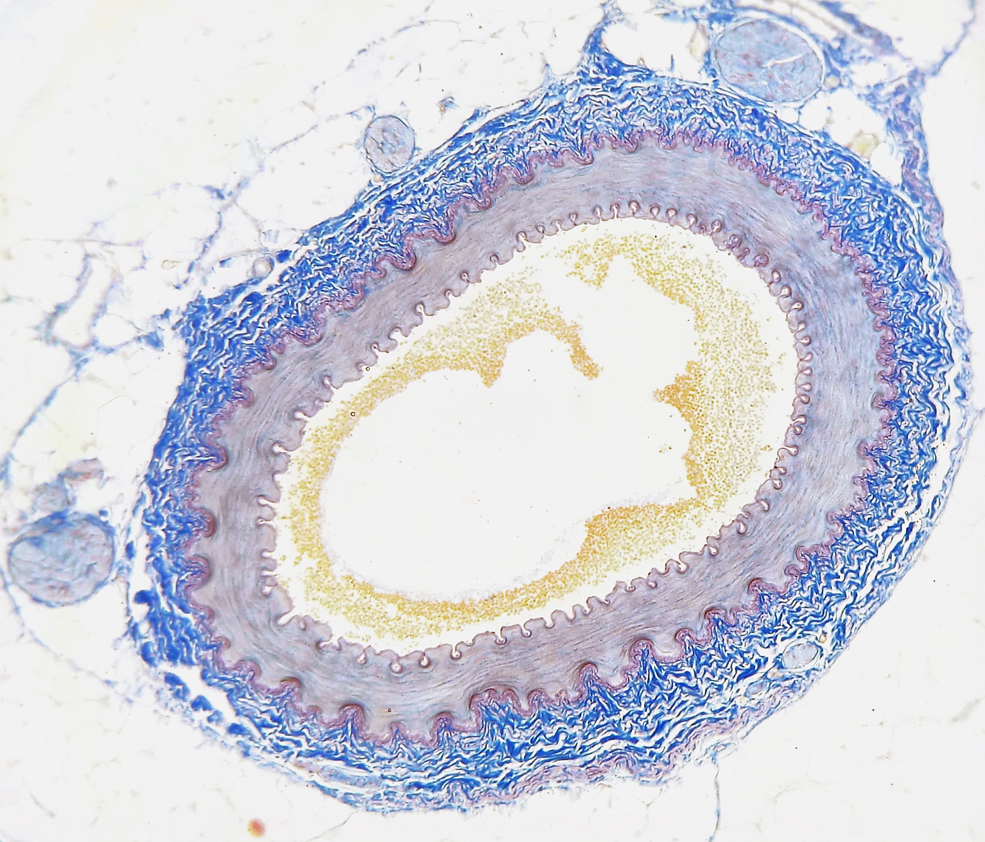 Querschnitt einer menschlichen Arterie mit Verkalkungen (gelb). © Wikimedia Commons
