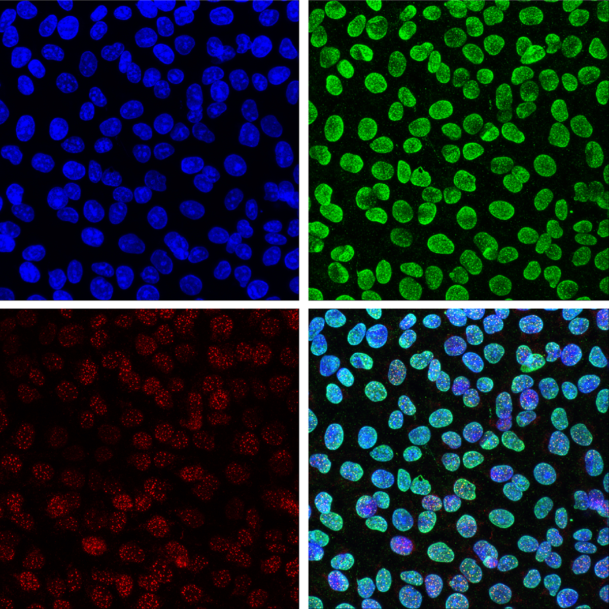 PARP Inhibitor-resistente Zellen mit wieder hergestellter DNA Reparatur. Blau: DNA in den Zellkernen (links oben); Grün: sogenannte PAR-Ketten welche als Plattform für DNA Repara-turproteine dienen (rechts oben); Rot: rekrutierte DNA Reparatur Proteine (links unten); Mix aller 3 Farben (rechts unten). © Universität Bern