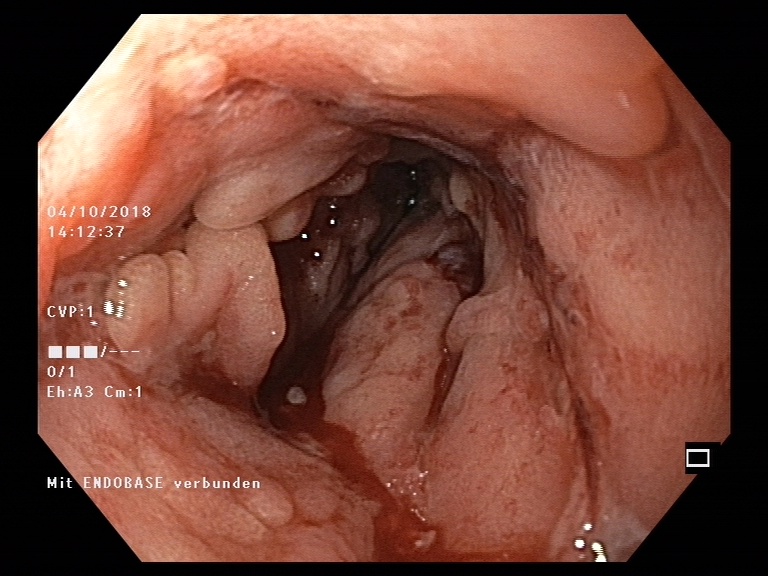 Endoskopische Aufnahme einer Dickdarmschleimhaut mit Morbus Crohn.  © Pascal Juillerat, Universität Bern