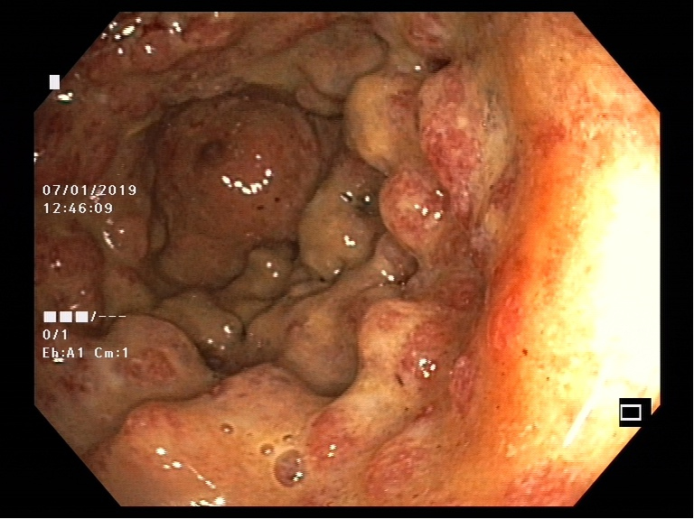 Endoskopische Aufnahme einer Dickdarmschleinhaut mit Colitis ulcerosa.  © Pascal Juillerat, Universität Bern
