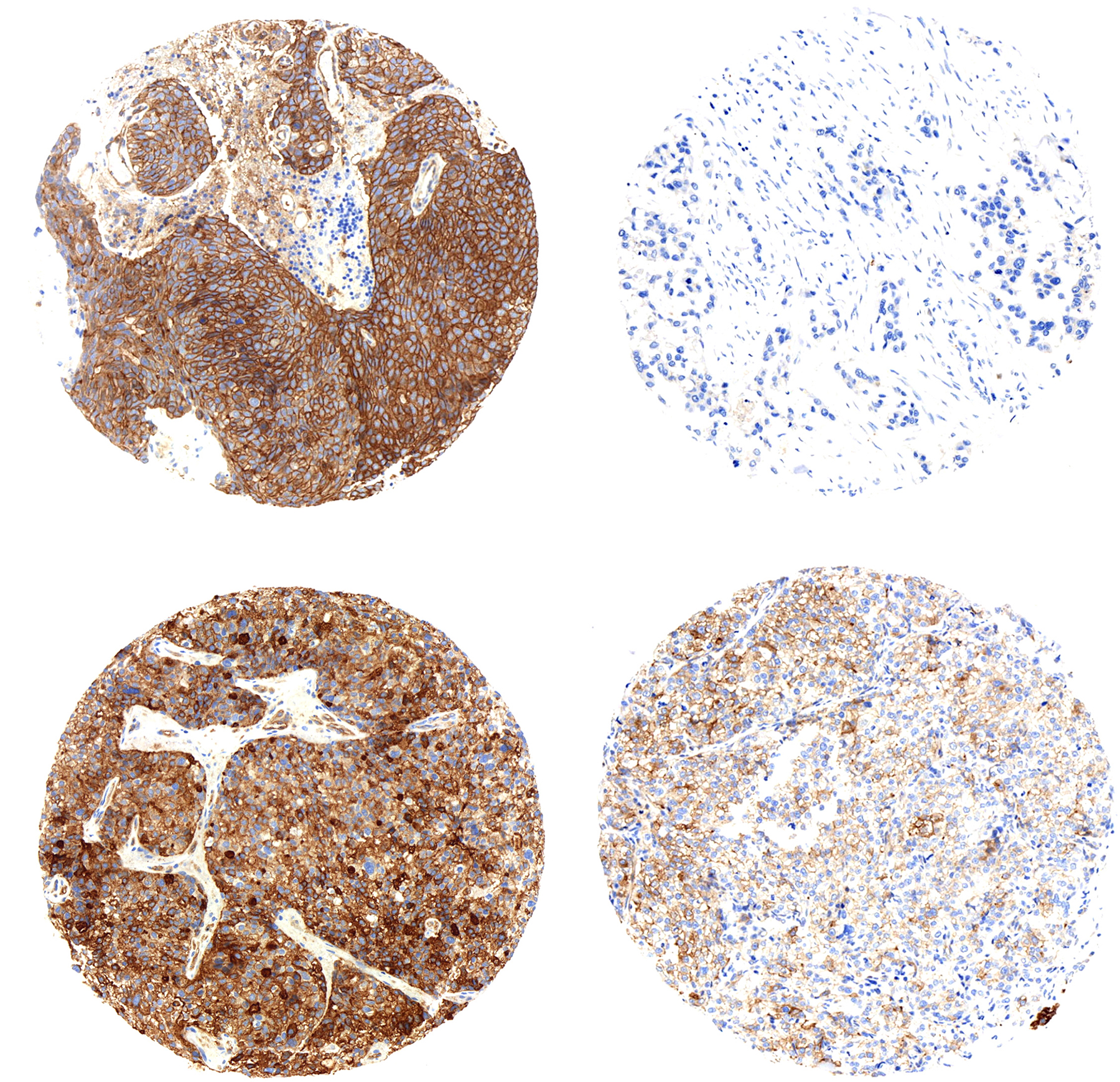 ngTMA® technology: Immunostaining of pGluN2B (Y1252) in brain metastases (Left column) and immunostaining of pGluN2B (Y1252) in breast primary tumor (Right column). Translational Research Unit. Institute of Pathology – University of Bern.