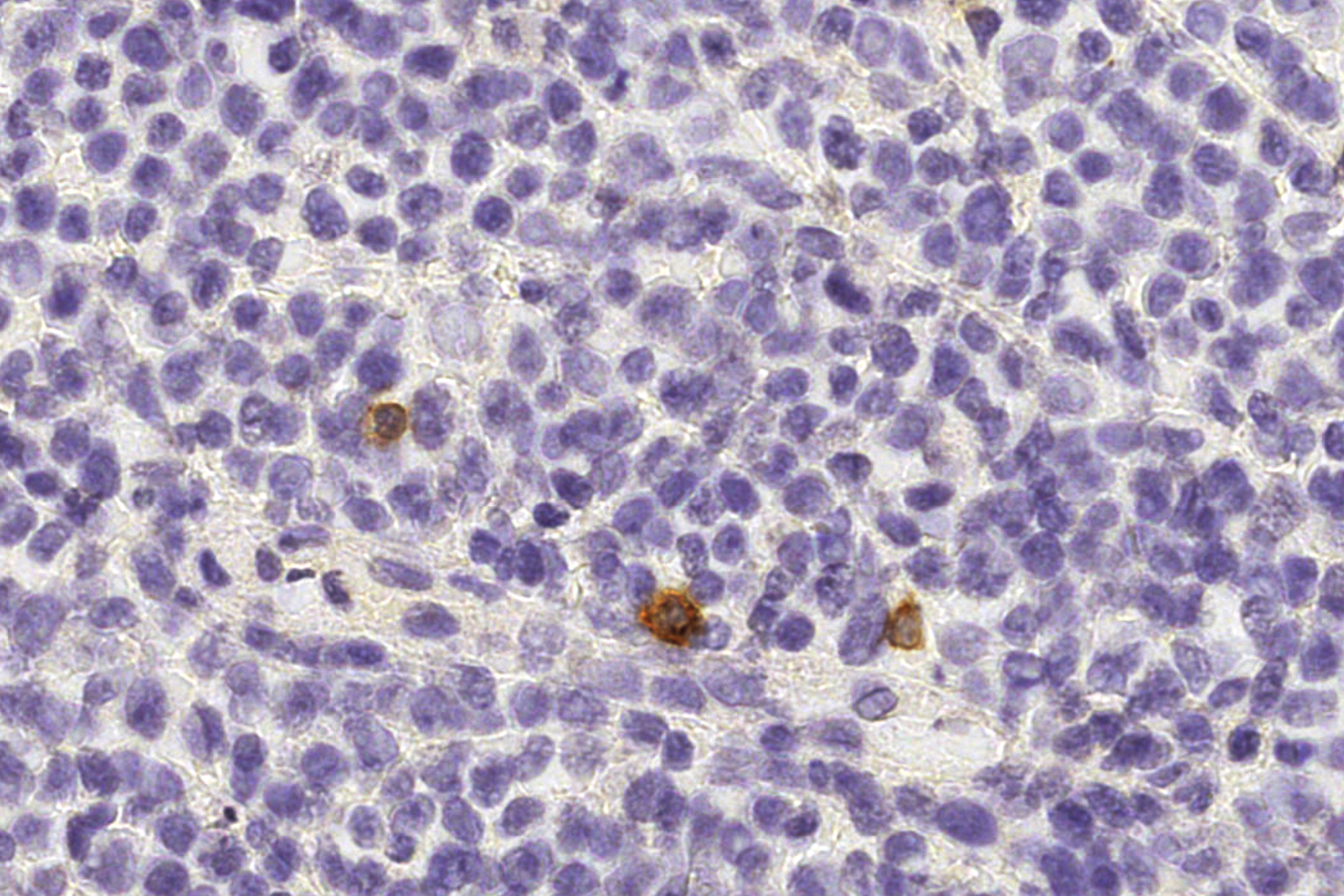NK-Zellen (braun) patrouillieren zwischen Zellen eines gesunden menschlichen Lymphknotens.