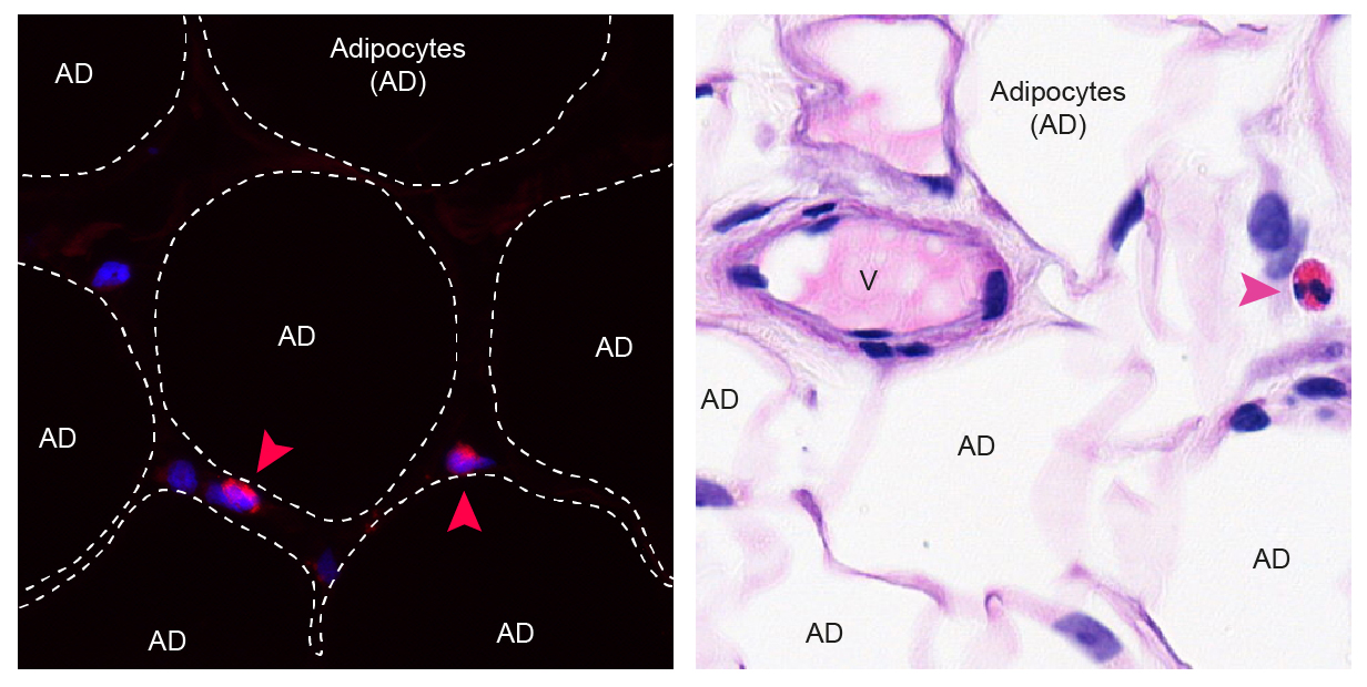 Nachweis von Eosinophilen in menschlichem Bauchfett mittels zwei unterschiedlicher Färbungen. Die Eosinophile sind mit einer Pfeilspitze markiert. AD: Adipozyten (Fettzelle), V: Blutgefäss.